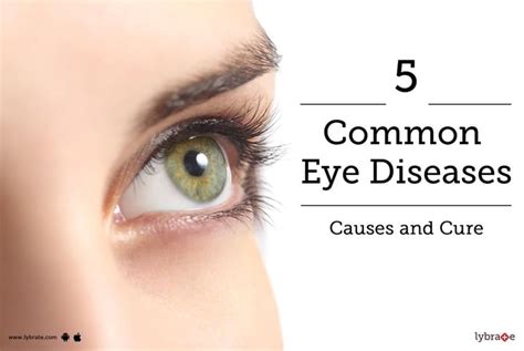 amd eye disease|5 most common eye conditions.